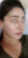 Nose Revision... — Korea cost, reviews & before-after | MISOODA