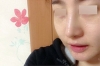 Nose Revision... — Korea cost, reviews & before-after | MISOODA