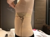 Liposcution surgery — Korea cost, reviews & before-after | MISOODA