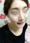 Nose Revision... — Korea cost, reviews & before-after | MISOODA