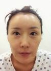 Jaw + Eyelid Revision, Accusculpt, Fat Graft — Korea cost, reviews & before-after | MISOODA