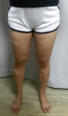 Thighs liposuction 2 — Korea cost, reviews & before-after | MISOODA
