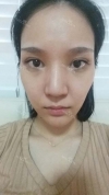 Beautiful eyes and Nose! — Korea cost, reviews & before-after | MISOODA