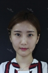 Water Injection for that baby smooth skin! — Korea cost, reviews & before-after | MISOODA
