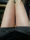 Lower body thigh liposuction — Korea cost, reviews & before-after | MISOODA