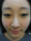 MISOODA — Korea cost, reviews & before-after | MISOODA