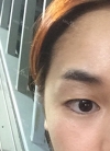 Twinkly Eyes! — Korea cost, reviews & before-after | MISOODA