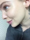 UK Model PIXIEE's skin treatment in Korea — Korea cost, reviews & before-after | MISOODA