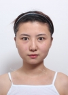 facial contouring.. 2 — Korea cost, reviews & before-after | MISOODA