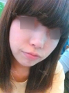 Nose Revision Surgery (3 times) — Korea cost, reviews & before-after | MISOODA