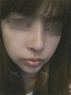 Nose Revision Surgery (3 times) — Korea cost, reviews & before-after | MISOODA
