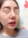 Nose Revision... — Korea cost, reviews & before-after | MISOODA