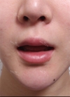 Lips and Fat Graft — Korea cost, reviews & before-after | MISOODA