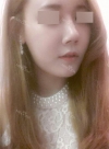 Rhinoplasty~! — Korea cost, reviews & before-after | MISOODA