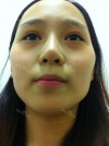 Facial Contouring Surgery+Square Jaw Reduction,+Chin Reduction,+Zygoma Reduction+Full face fat graft — Korea cost, reviews & before-after | MISOODA
