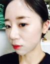 chin-+-rhinoplasty — Korea cost, reviews & before-after | MISOODA