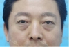 Baggy eyes — Korea cost, reviews & before-after | MISOODA