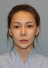 Nose Revision — Korea cost, reviews & before-after | MISOODA