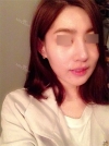 Nose Revision... — Korea cost, reviews & before-after | MISOODA