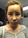 Jaw Reduction, Rhinoplasty and Breast Augmentation in Korea — Korea cost, reviews & before-after | MISOODA