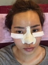 Jaw Reduction, Rhinoplasty and Breast Augmentation in Korea — Korea cost, reviews & before-after | MISOODA