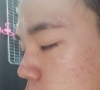 nose revision real review — Korea cost, reviews & before-after | MISOODA