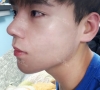 nose revision real review — Korea cost, reviews & before-after | MISOODA