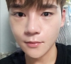 nose revision real review — Korea cost, reviews & before-after | MISOODA