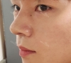 nose revision real review — Korea cost, reviews & before-after | MISOODA