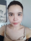Eye, Nose, Micro Fat Grafting surgery real reviews! — Korea cost, reviews & before-after | MISOODA