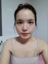 Eye, Nose, Micro Fat Grafting surgery real reviews! — Korea cost, reviews & before-after | MISOODA
