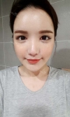 Eye, Nose, Micro Fat Grafting surgery real reviews! — Korea cost, reviews & before-after | MISOODA