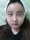 Eye, Nose, Micro Fat Grafting, Facial bone contouring surgery — Korea cost, reviews & before-after | MISOODA