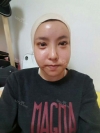 My face looks perfectly normal now — Korea cost, reviews & before-after | MISOODA