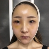 Eye, Nose, Micro Fat Grafting, Facial bone contouring surgery! — Korea cost, reviews & before-after | MISOODA