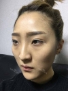 Eye, Nose, Micro Fat Grafting, Facial bone contouring surgery! — Korea cost, reviews & before-after | MISOODA