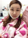 Eye, Nose, Micro Fat Grafting, Facial bone contouring surgery~! — Korea cost, reviews & before-after | MISOODA