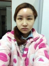 Eye, Nose, Micro Fat Grafting, Facial bone contouring surgery~! — Korea cost, reviews & before-after | MISOODA