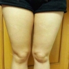 body, breast surgery — Korea cost, reviews & before-after | MISOODA