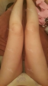 breast, body, calf high frequency — Korea cost, reviews & before-after | MISOODA