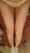 breast, body, calf high frequency — Korea cost, reviews & before-after | MISOODA