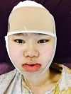 Two-jaw + Ar + Zy + T + Front zygoma(sil) + forehead (sil) + calibration O (ceramic) — Korea cost, reviews & before-after | MISOODA