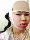 Two-jaw + Ar + Zy + T + Front zygoma(sil) + forehead (sil) + calibration O (ceramic) — Korea cost, reviews & before-after | MISOODA