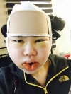Two-jaw + Ar + Zy + T + Front zygoma(sil) + forehead (sil) + calibration O (ceramic) — Korea cost, reviews & before-after | MISOODA