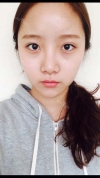 Ni (ptosis) + Epi + Tr + Rhino (re) Nasal septum + Rt Ear cartilage — Korea cost, reviews & before-after | MISOODA