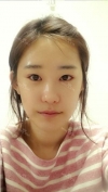 Two jaw + Ar + Zy + T + Ni + Lat + Bottom + Epi + Rhino + F/g — Korea cost, reviews & before-after | MISOODA