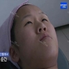 More natural, more Beautiful. The harmony of facial features! — Korea cost, reviews & before-after | MISOODA