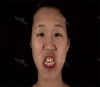 More natural, more Beautiful. The harmony of facial features! — Korea cost, reviews & before-after | MISOODA