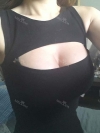 Tear-drop shaped implants improve my confidence efficiently — Korea cost, reviews & before-after | MISOODA