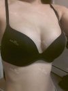 Tear-drop shaped implants improve my confidence efficiently — Korea cost, reviews & before-after | MISOODA